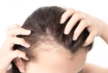 Female Pattern Baldness