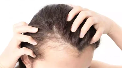 Female Pattern Baldness