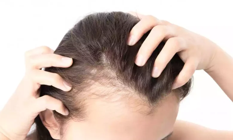 Female Pattern Baldness