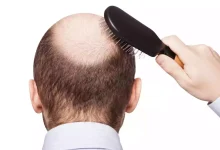 Male Pattern Baldness