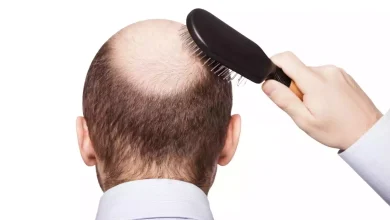 Male Pattern Baldness