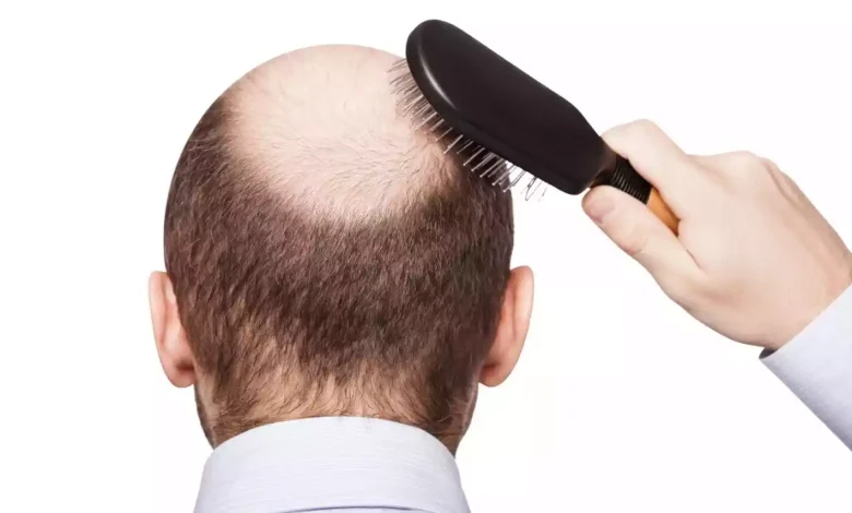 Male Pattern Baldness